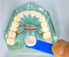 上あごの拡大装置の回し方