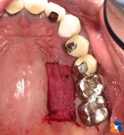 上あごの分厚い歯肉を下あごへ移植する