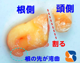 歯の根の先が尖って曲がっている