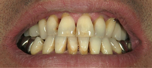 目立たない入れ歯