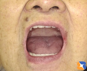 お口を全開しても入れ歯は落ちてこない