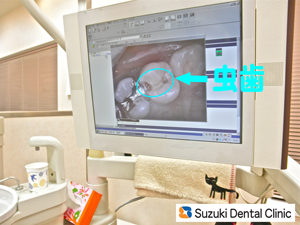 虫歯の大きさ、色、深さ、本数、確認して下さい。