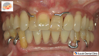 同じ入れ歯でもここまでやります