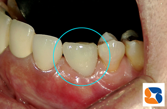 審美のオールセラミックが完成　