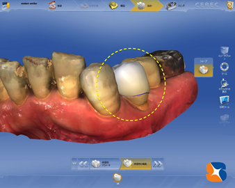 CADで歯の形を製作