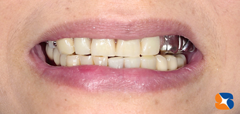 治療が終わった後の口元