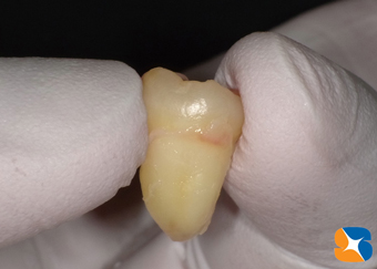 歯の根はあらゆる方向に生えている