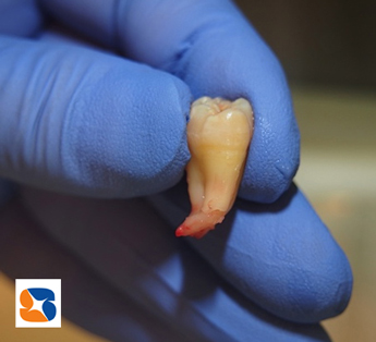 親知らずの根の先が90度に折れ曲がる