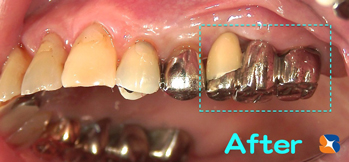 右から３連結のブリッジ