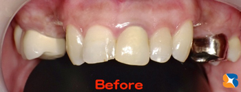 前歯と奥歯の中間部に歯がない