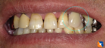 入れ歯に見えなデザイン入れ歯