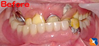 良く噛める入れ歯　見た目のよい入れ歯　東大阪