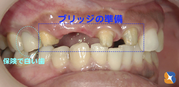 保険で銀歯は昔。今は保険で白い歯を入れることが可能