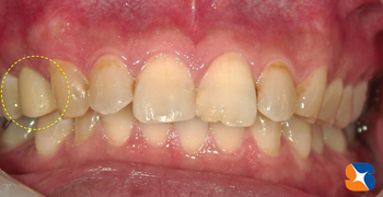 ２年前から保険で白く出来るようになりました