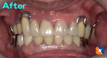 小さく目立たない入れ歯を保険で作る