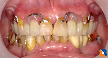 保険の入れ歯でもここまでやる！