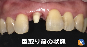 歯茎の手術　エムドゲイン