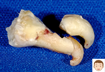 根の先が引っ掛って難航した親知らず