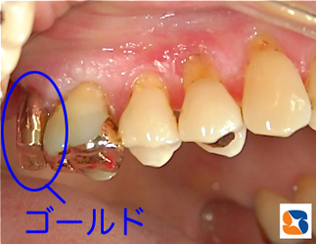 奥歯を金属で修復