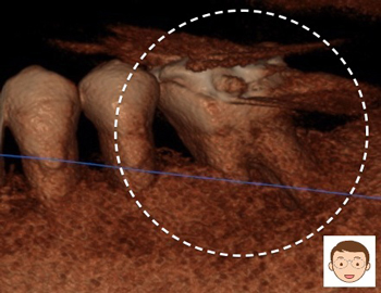 CTで３D画像化　正確に神経が抜ける　