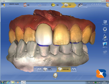 CADで理想的な形の前歯をドクターが設計