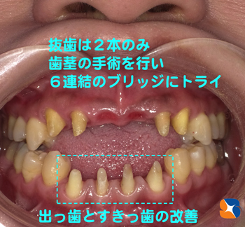 歯茎の施術を行い、歯周ポケットを無くす