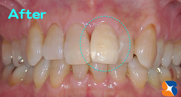 金属不使用　オールセラミック　80,000円