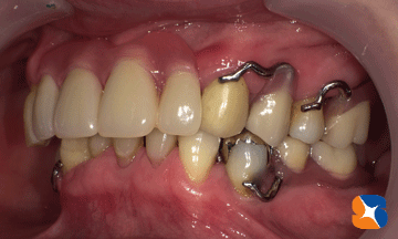 左サイドから見た入れ歯