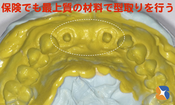 保険の前歯ブリッジ　シリコン印象　材料こだわり　