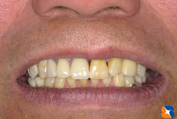 入れ歯と判りにくい保険の入れ歯