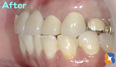 ６連結の前歯のブリッジ　良好な結果に満足