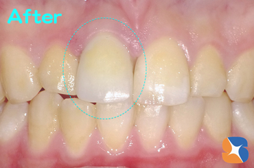 事故した日にセラミックが出来上がり＆納品も済ませる