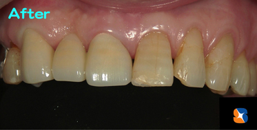 保険の完成ブリッジ