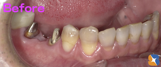 奥歯を半分にして残す