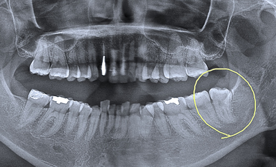 親知らずをお口全体のレントゲンでチェック