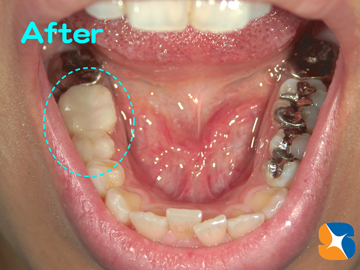 白いセラミックの詰め物に代える