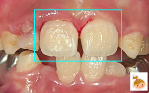 事故で前歯がグラつく　出血する