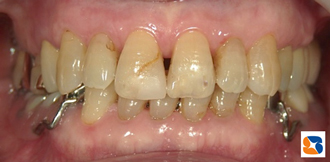 ホワイトニング前