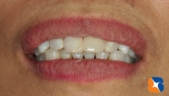 綺麗になった口元