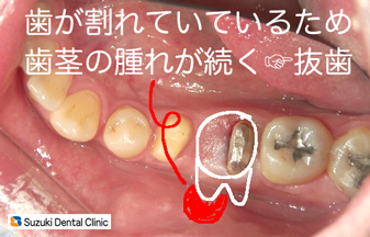 歯を抜かずに残す