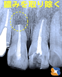 グラグラ止まらず　手術して膿みを除去