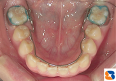 下の歯並びを広げる装置