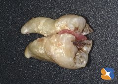 親知らず　根の先が曲がっていると抜歯がより困難となる