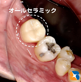 奥歯でもセラミックは美しい