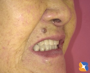 見た目も美しい入れ歯