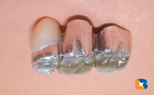 ３連結のブリッジ