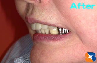 入れ歯を毎日、快適に使っています