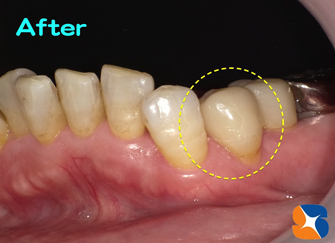 セラミックのブロックを削って歯を短時間で製作