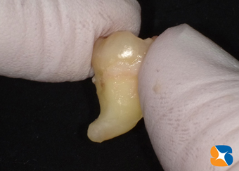 根の曲がりが強ければなかなか歯が抜けてくれない