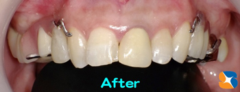 鈴木式デザイン入れ歯